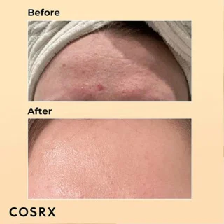 اسنس حلزون کوزارکس برای ترمیم جای جوش